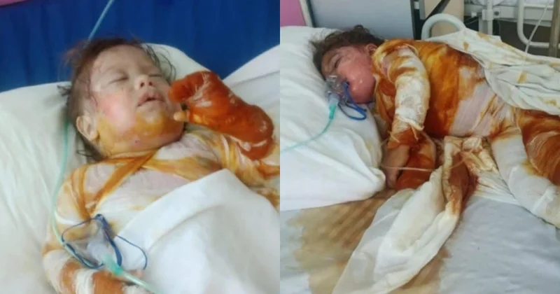 İki bacı ağır yanıq xəsarətləri alıb: Təcili dəstəyə ehtiyacları var