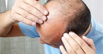 Yaponlar keçəlliyə qarşı təbii vasitə tapıblar...