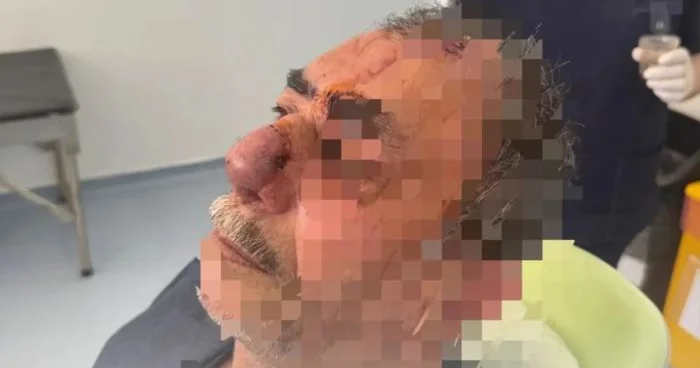 İt dişləməsi nəticəsində burnunu itirən xəstəyə yeni burun formalaşdırıldı Azərbaycanda unikal əməliyyat