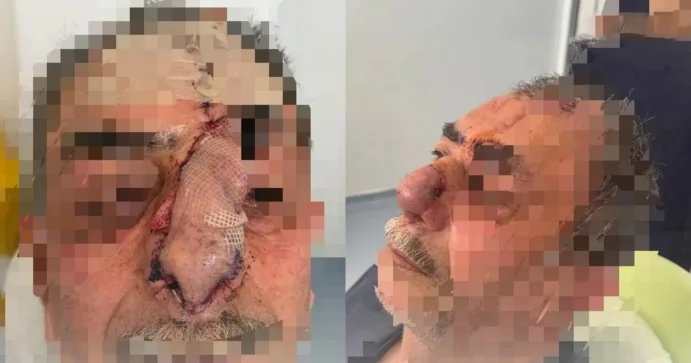İtin parçaladığı burun bərpa edildi Azərbaycanda unikal əməliyyat