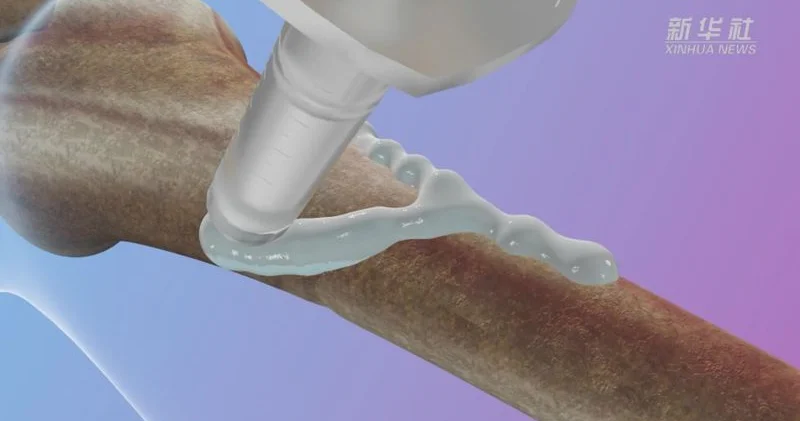 Çin alimləri sınıqları 3 dəqiqəyə sağaldan “sümük yapışdırıcısı” hazırladılar