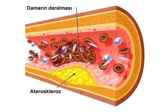 Ateroskleroz ürəkdamar sistemi xəstəliklərinin əsas səbəbidir