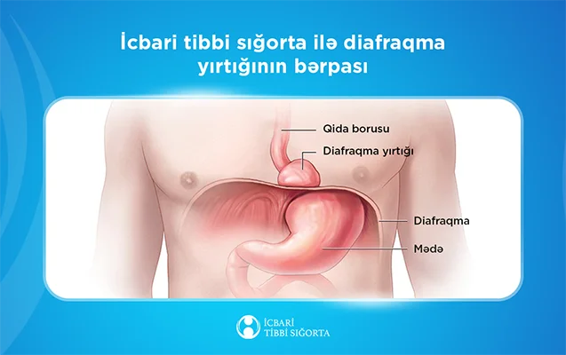 Diafraqmal yırtıqların bərpası icbari tibbi sığorta təminatına daxildir