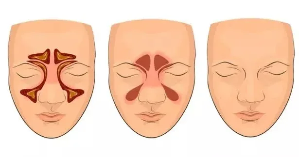 Həftələrlə keçməyən burun tutulmasının səbəbi nədir?