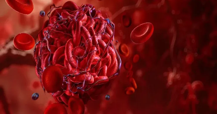 Bu, həyatınızı xilas edə bilər: Qanın laxtalanmasının 5 əlaməti