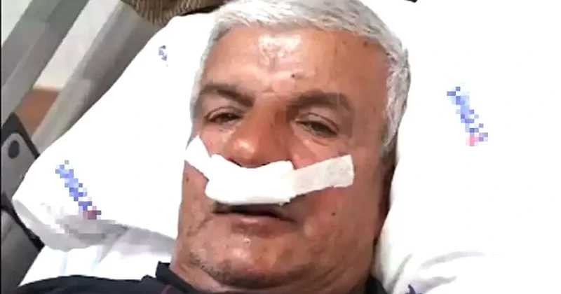 Peşə səbəbindən yaranıb!  65 yaşlı kişinin burnundan daş çıxarıldı