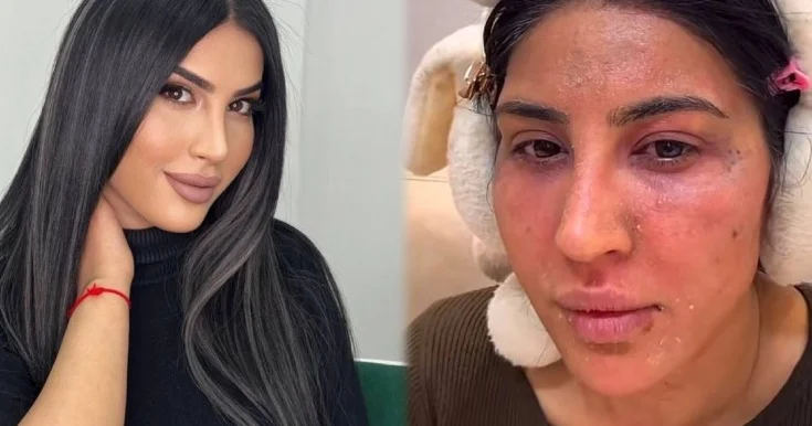 Reklam etdiyi pilinq Ləmanın üzünü yandırdı Video