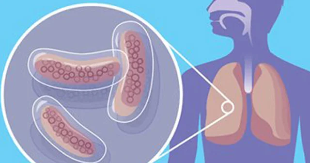 Adı vahiməli, özü incə dərd: vərəm