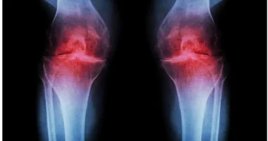 Alimlər diz ağrısının çarəsini tapdılar