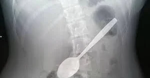 Sərxoş kişi qaşıq uddu 5 ay xəbərsiz gəzdi
