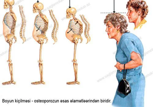 Osteoporoz lal epidemiya