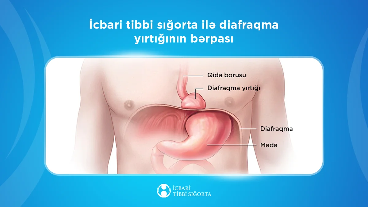 Diafraqmal yırtıqların bərpası icbari tibbi sığorta təminatına daxildir