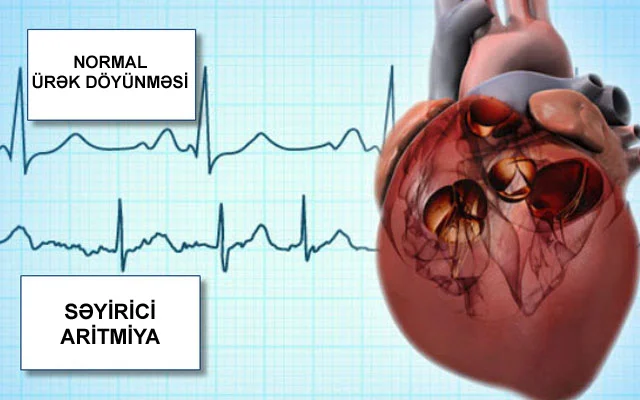 Səyirici aritmiya İNSULTA səbəb olur. Simptomlar, müalicə