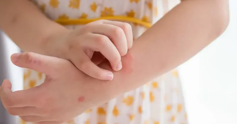 Чесотка в школах Тбилиси? Наццентр контроля заболеваний Грузии сделал заявление