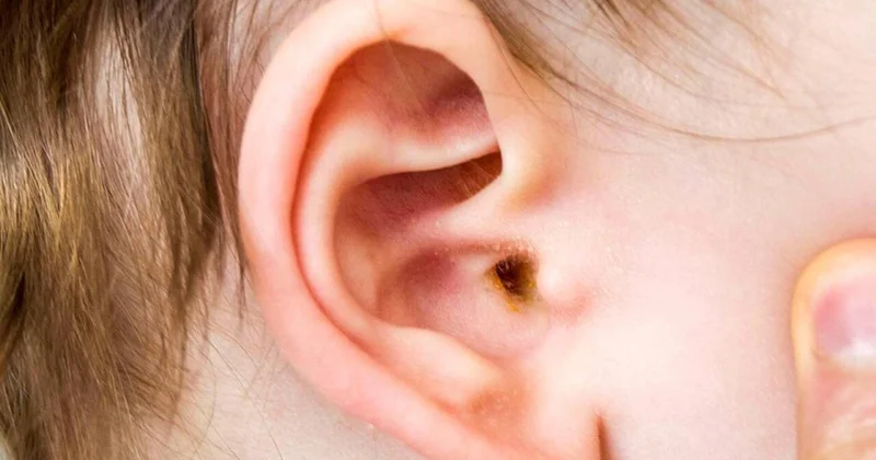 Uşaqlarınızda bu əlamətlər varsa, həkimə aparın Yoxsa kar qala bilər