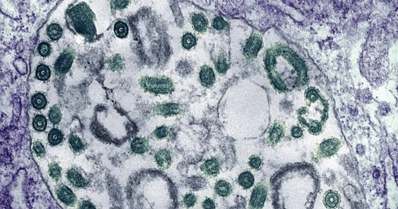 Covid keçirmiş insanlarda qan laxtalanır Həkimdən xəbərdarlıq