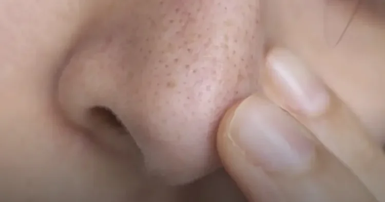 Qara nöqtələri sıxmağın TƏHLÜKƏLƏRİ