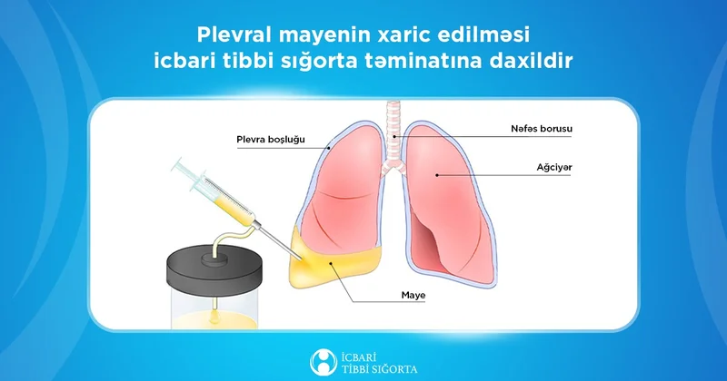 Ağciyərlərə yığılmış mayenin çəkilməsi məqsədilə 5643 prosedur icra olundu