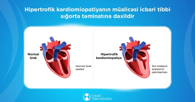 Hipertrofik kardiomiopatiyanın müalicəsi icbari tibbi sığorta təminatına daxildir