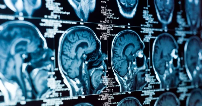 Beyində demensiyanın gözlənilməz səbəbi tapıldı