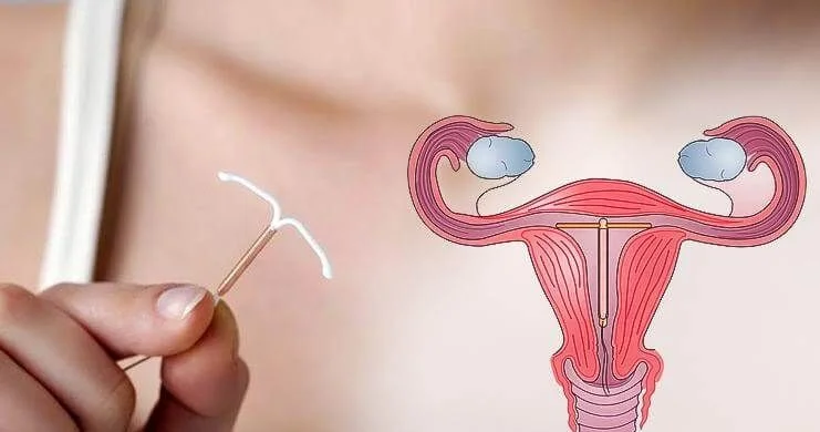 Spiral xərçəngə səbəb olur? Ginekoloqdan cavab