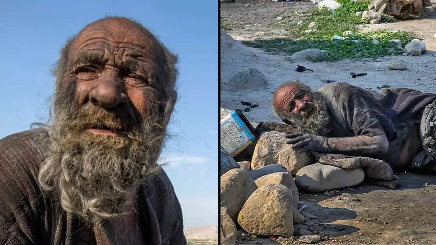 Dünyanın ən çirkli adamı 60 il duş qəbul etməməsinin faciəvi səbəbi FOTO