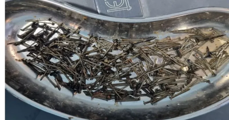 В Узбекистане из желудка мужчины извлекли 200 граммов гвоздей