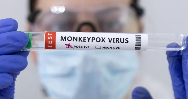 Bu ölkədə aqressiv meymunçiçəyi ştamına ilk yoluxma qeydə alınıb