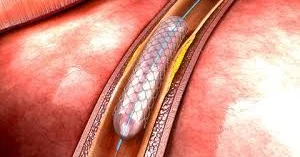 Ürəyə stent hansı hallarda qoyulur?