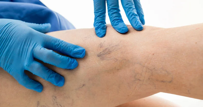 Damar xəstəlikləri nədən yaranır? Arterial problemlər barədə bilinməyənlər
