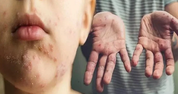 Uşaqlarda qorxulu virus: Əllərdə, ayaqlarda, ağızda səpkilər müalicəsi yoxdur Həkimdən SOS