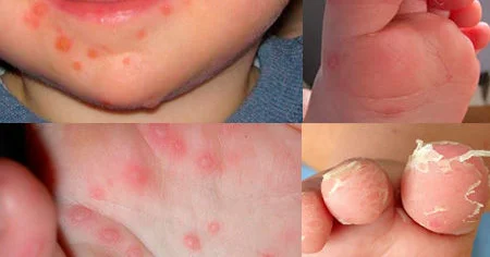 Uşağınızın əlində, ayağının altında içi dulu səpkilər varsa… Həkimdən VALİDEYNLƏRƏ XƏBƏRDARLIQ