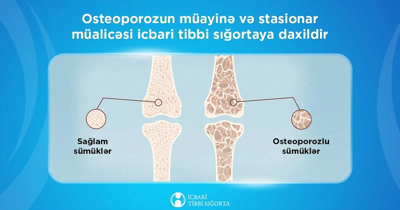 Osteoporozun müayinə və stasionar müalicəsi icbari tibbi sığortaya daxildir