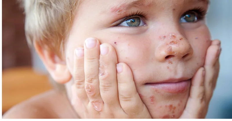 Valideynlərin DİQQƏTİNƏ! Uşaqlar arasında bu virus yayılıb…
