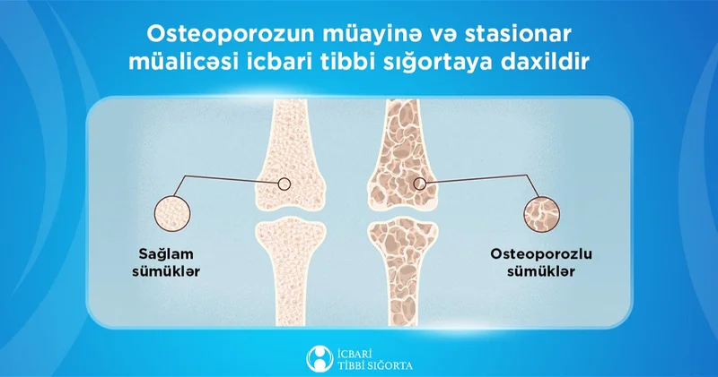 Обследование и стационарное лечение остеопороза включены в ОМС