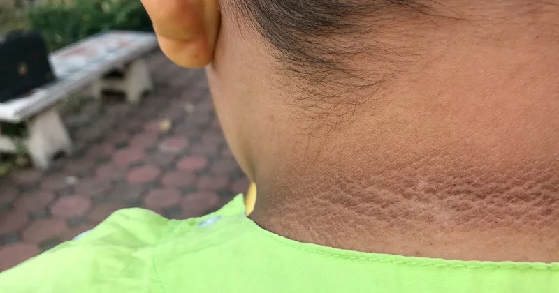 Boynun və qoltuqaltının qaralmasının gizli səbəbləri