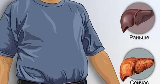 Yağlı qaraciyəri xilas etmək olarmı?