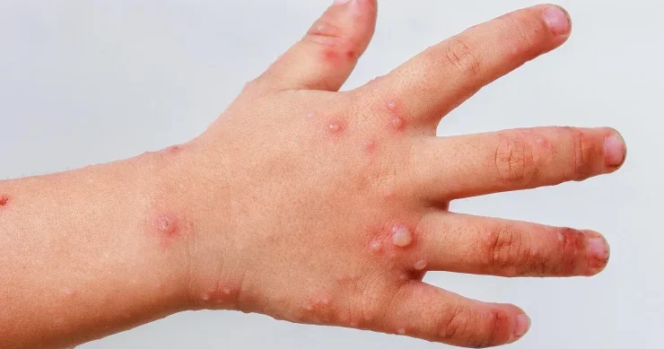 Çimərliklərdən uşaqlara virus yayılır? Suçiçəyinə bənzəyir, lakin...