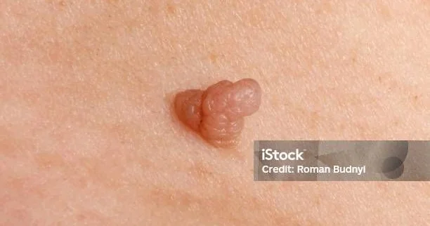 Kişi cinsiyyət üzvlərində papilloma Evli kişilərə xəbərdarlıq