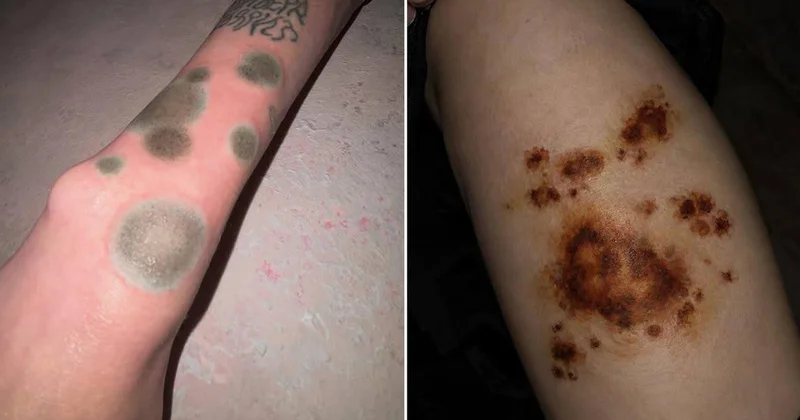 İlk baxışda xəstəlik kimi görünür: Rusiyada yeni döymə trendi ŞOK yaratdı