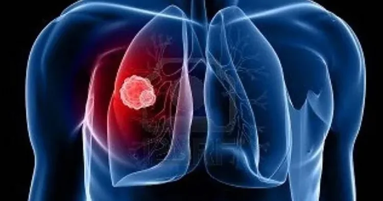 Alimlər ağciyər xərçənginin xroniki iltihabdan başladığını müəyyən ediblər