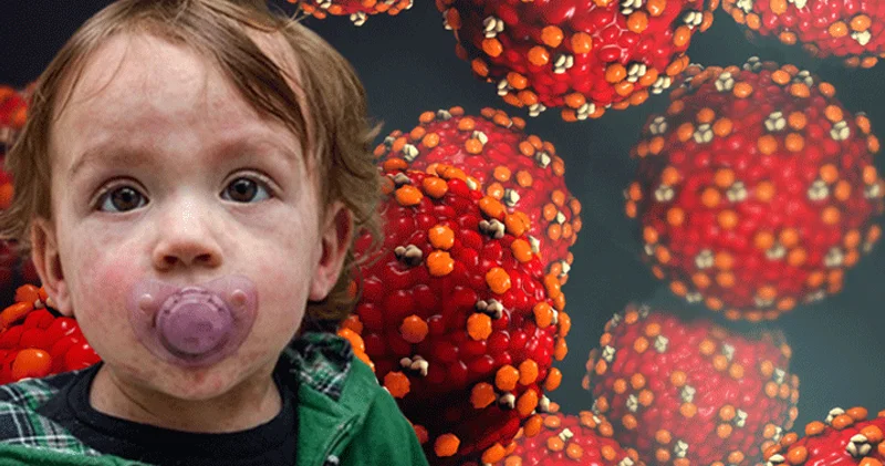 Səssizcə yayılır: Dünyada qızılca halları və ölümlərin sayı artır