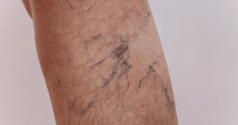 Müəllim və oğlu həşərat sancmasından ölüb