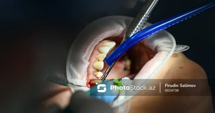 Удалить зуб целый квест: почему простая процедура превратилась в Азербайджане в сложный процесс?