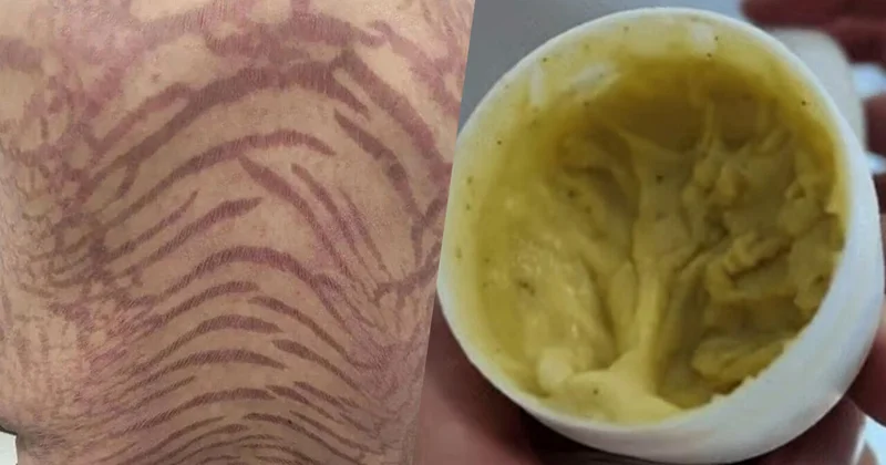 На коже женщины после самолечения появились змеиные узоры