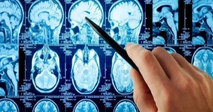 Kasıblar varlılardan daha çox insult keçirirlər