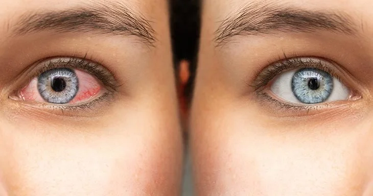 Quru göz sindromu: Rəqəmsal həyatın gizli və güclü problemi ARAŞDIRMA