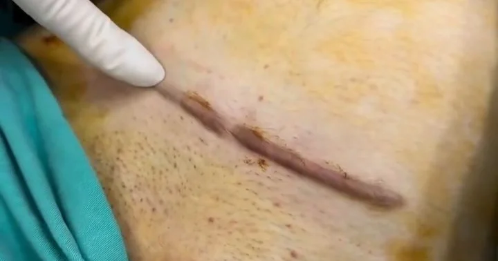 Kelleoid çapığı nədir? Həkimdən cavab