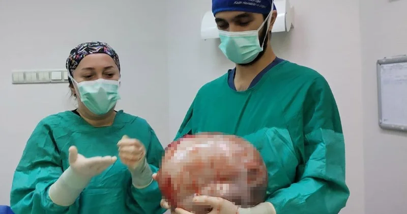 Qadının qarnından 9 kiloqramlıq şiş çıxarıldı FOTO