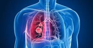 Vərəmdən əziyyət çəkənlər üçün YENİLİK